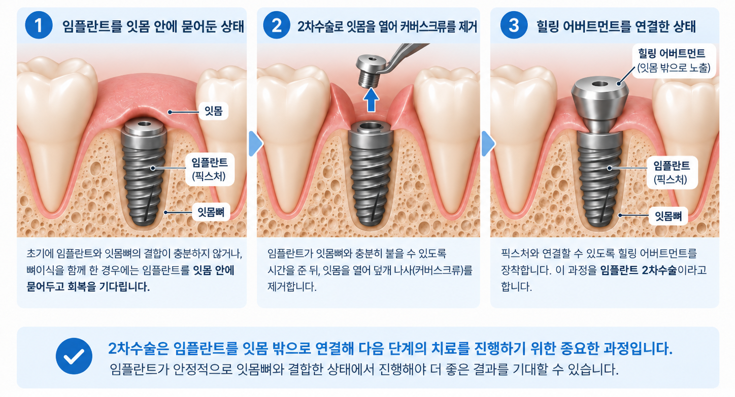 임플란트 2차수술의 이유와 과정 설명 이미지