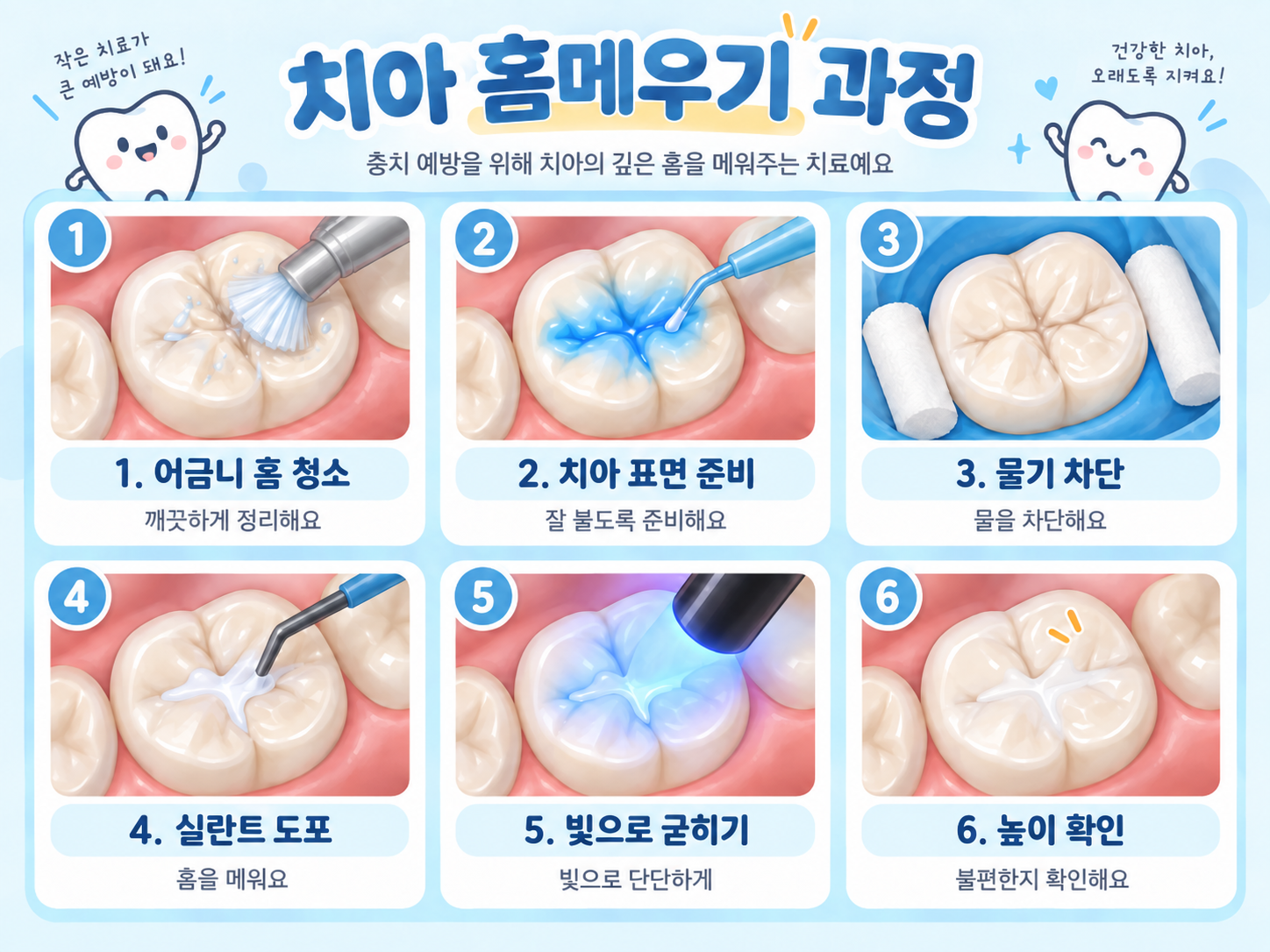 치아 홈메우기, 충치가 생기기 전에 하는 예방치료 설명 이미지