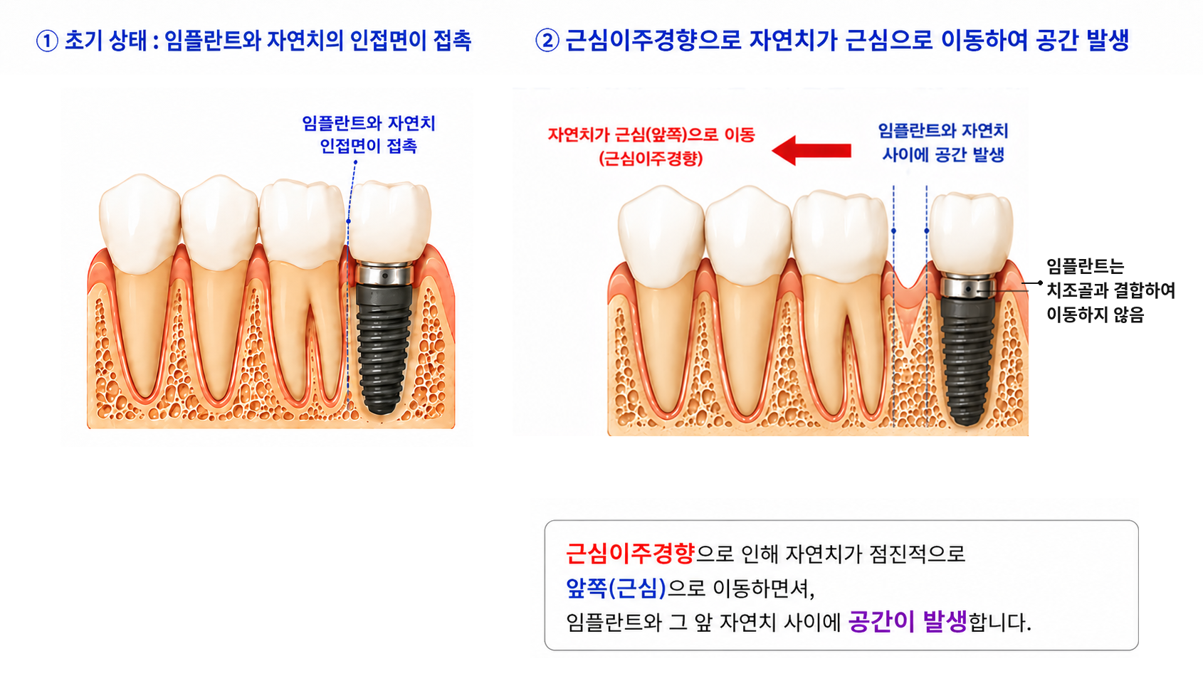 임플란트 옆에 음식물이 끼는 이유 설명 이미지