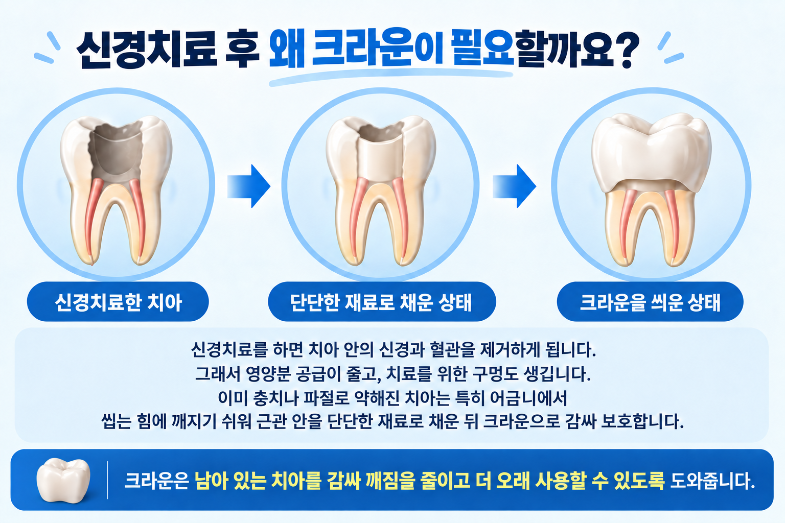 신경치료 후 크라운으로 치아를 보호하는 이유 설명 이미지