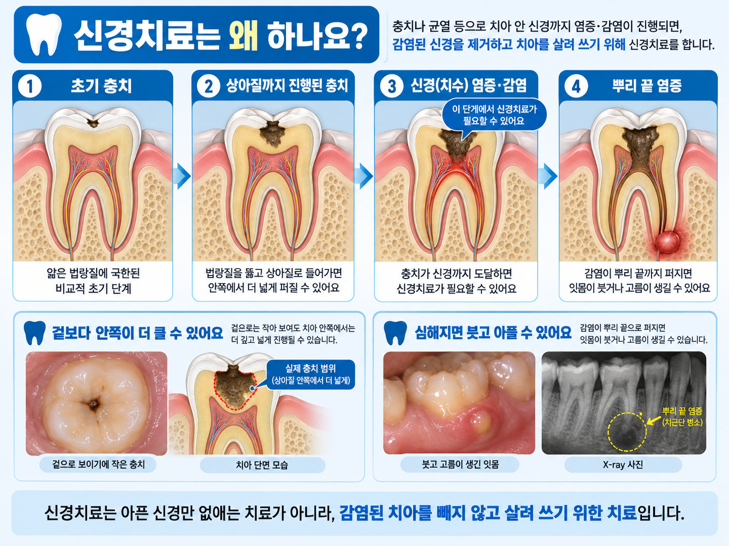 신경치료가 필요한 경우와 치료의 목적 설명 이미지