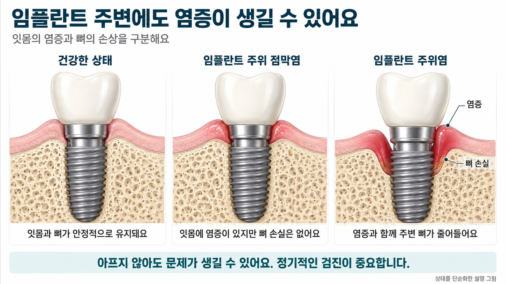 임플란트 주위 점막염과 임플란트 주위염 설명 이미지