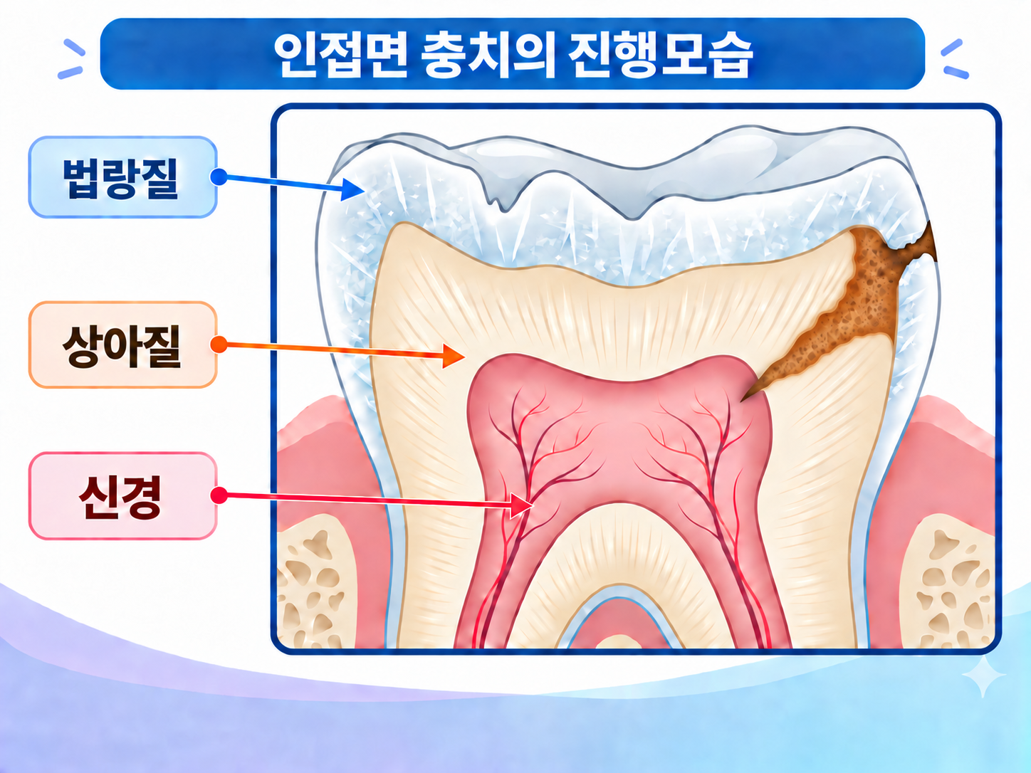 치아 사이 충치가 늦게 발견되는 이유 설명 이미지