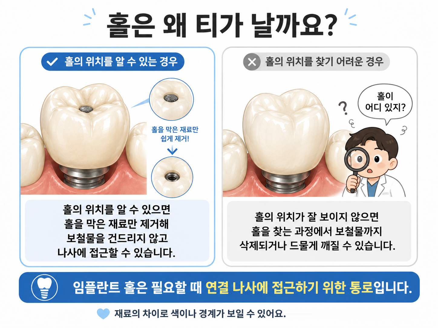 앞니 임플란트 보철의 고정 방식과 심미성 설명 이미지