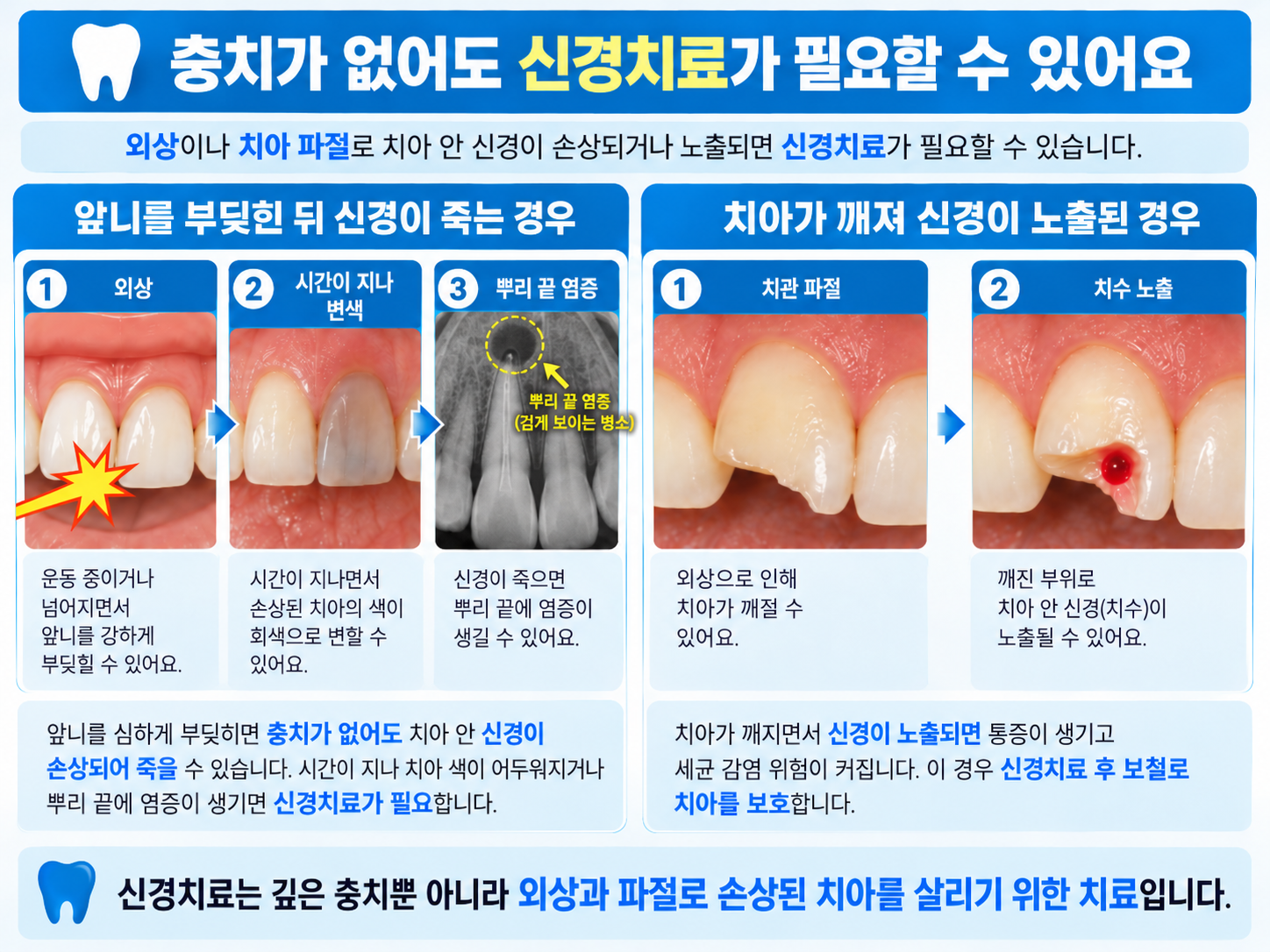 신경치료가 필요한 경우와 치료의 목적 설명 이미지