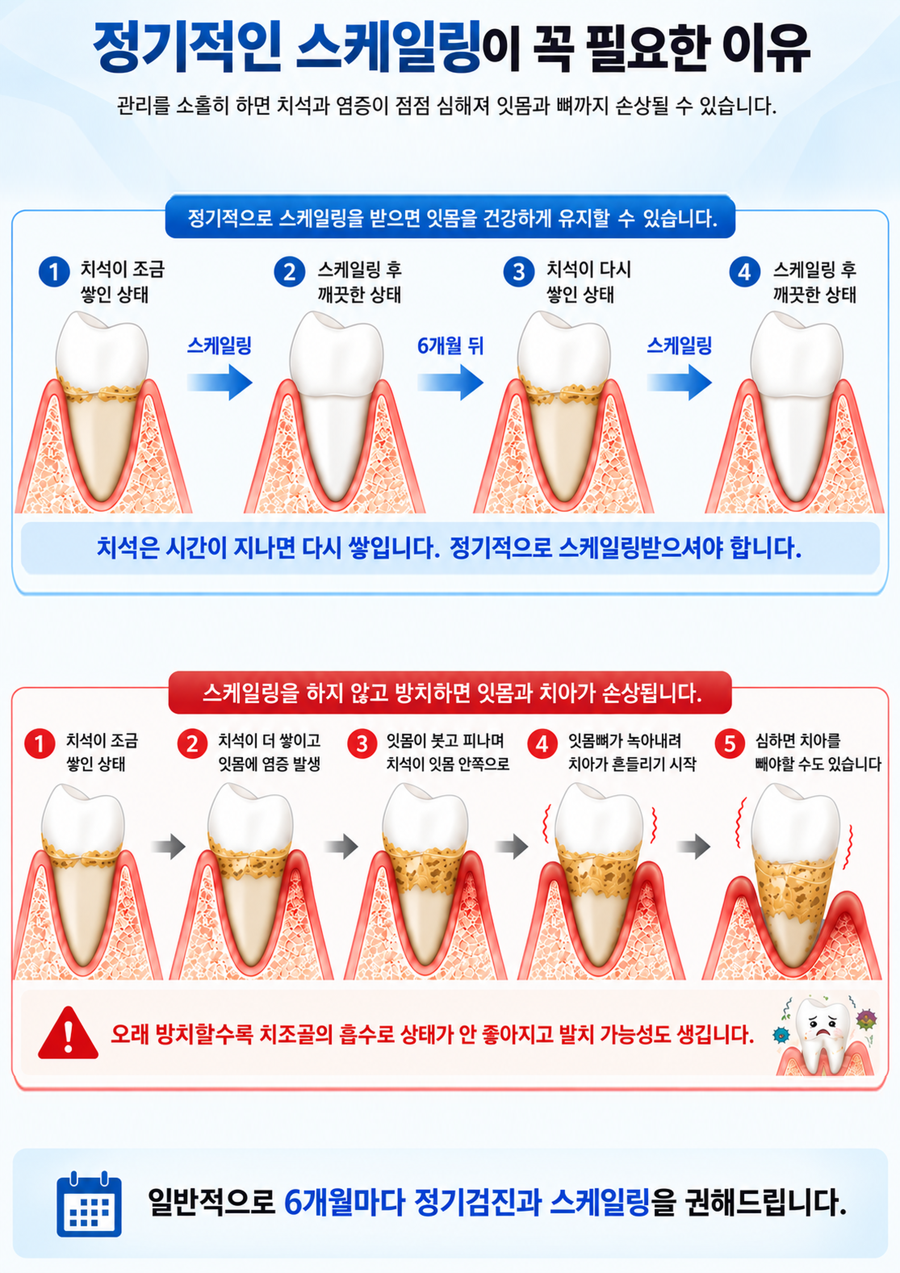 보험 스케일링 연 1회와 6개월 관리의 차이 설명 이미지