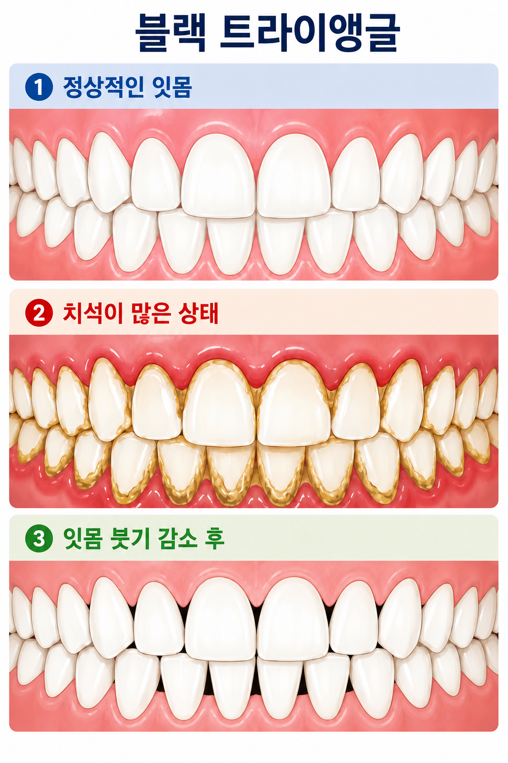 스케일링 후 블랙트라이앵글 설명 이미지