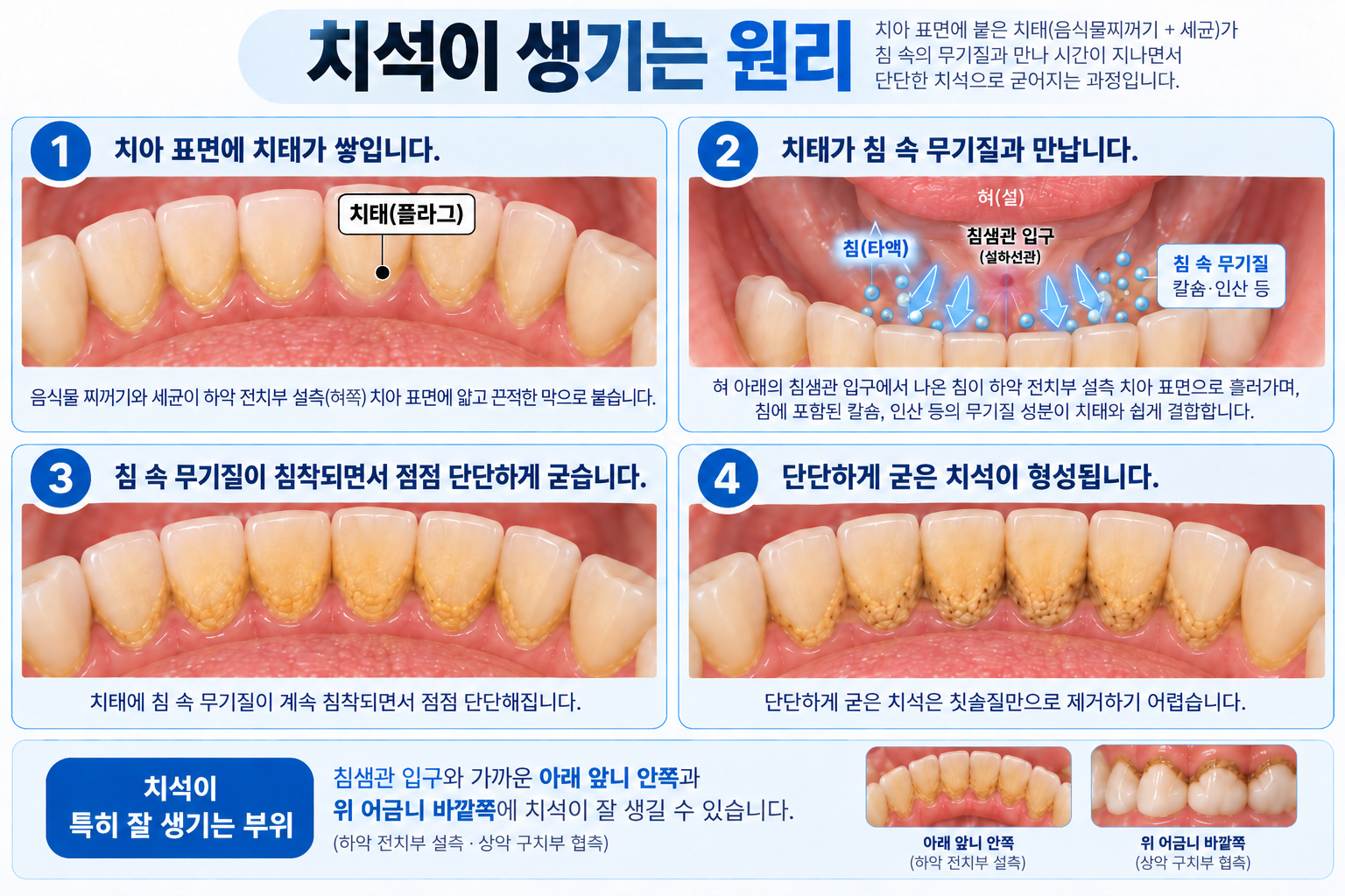 치태가 치석으로 변하는 과정 설명 이미지